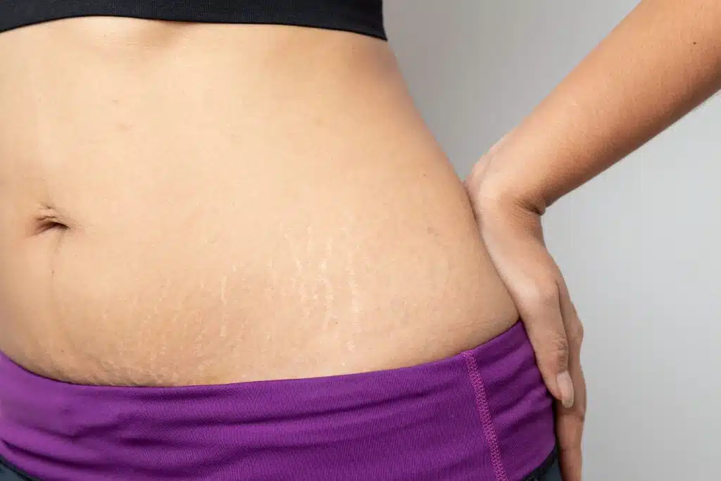 Woman with stretch marks