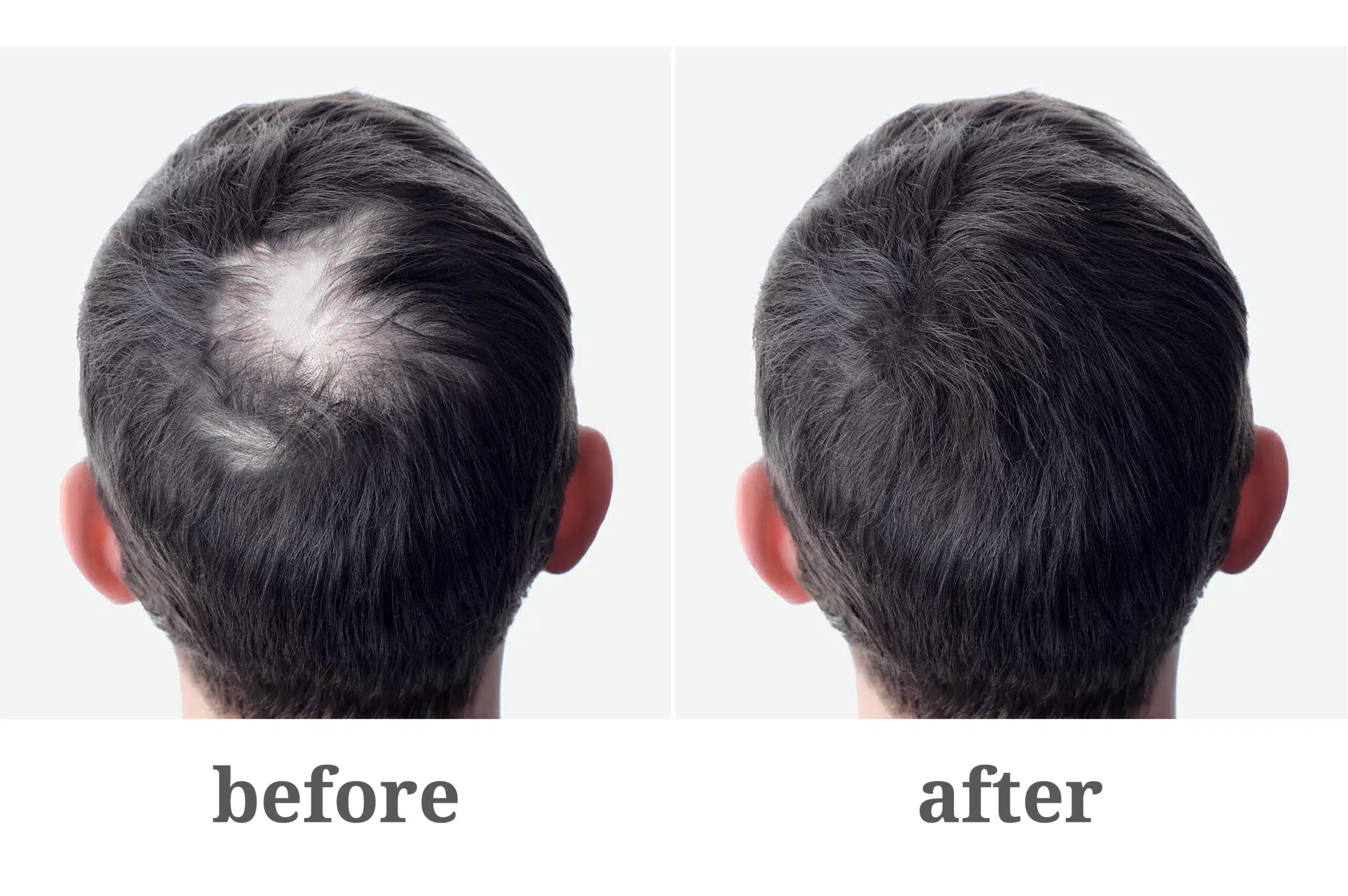 What is the best cure for hair loss or hair loss treatment?