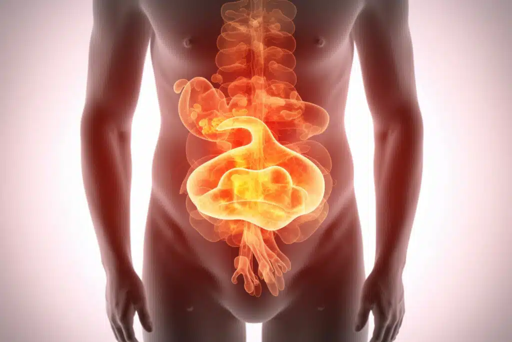 Are acid reflux and hemorrhoids related