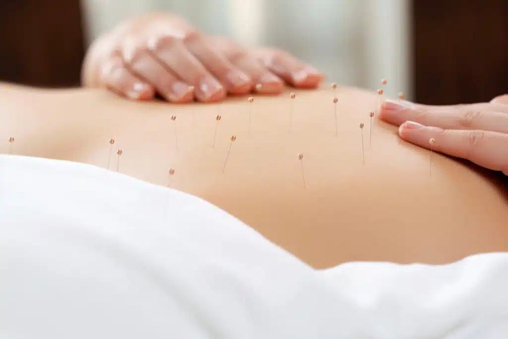 acupuncture for hemorrhoids reviews