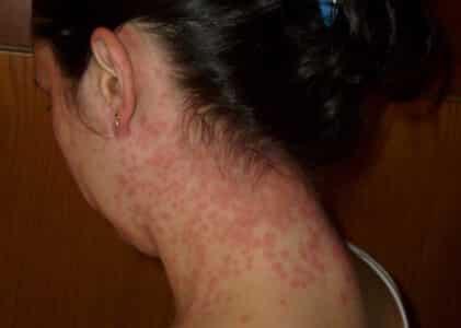 Wow, you can get petechiae from stress?